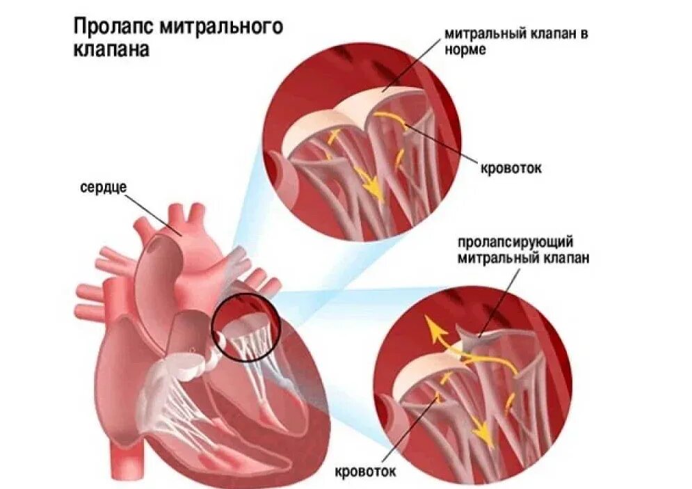 Что такое пролапс митрального клапана. Пролапс нейтрального клапана сердца 1 степени. Пролапс митрального клапана 1 степени с регургитацией. Пролабирование створок митрального клапана 1 степени.