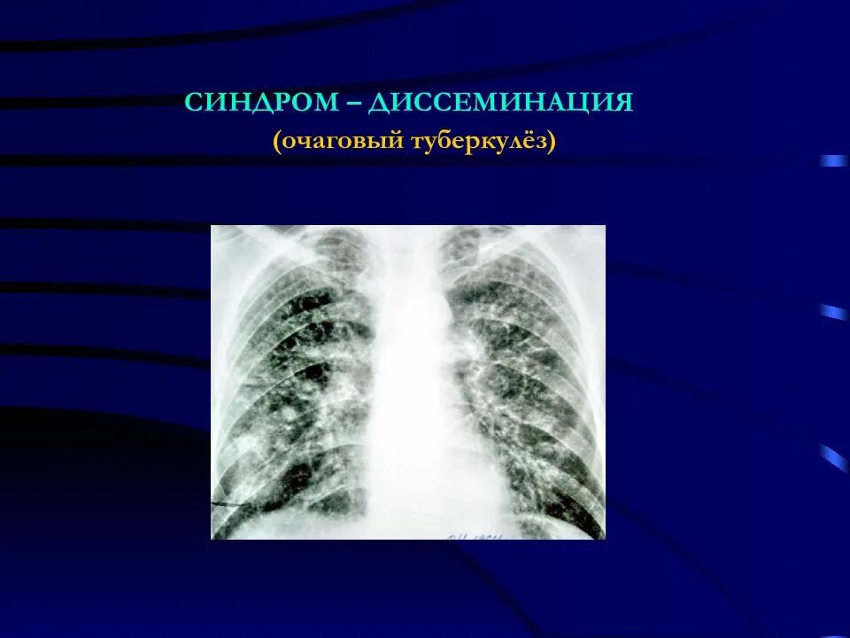 Диссеминированное поражение легких. Синдром диффузной диссеминации рентген. Синдром ограниченной диссеминации рентгенограмма. Очаговая диссеминация рентген. Синдром диссеминации легочной ткани на рентгене.