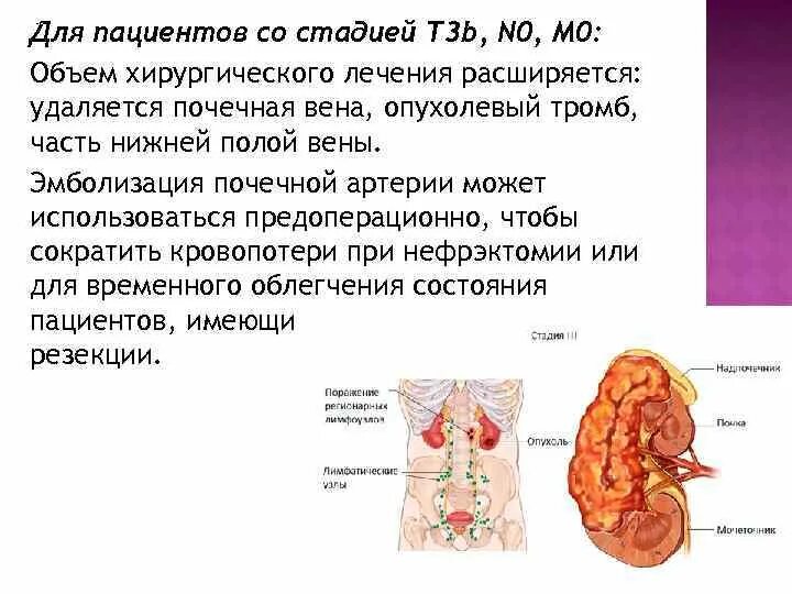 3 стадия рака почки