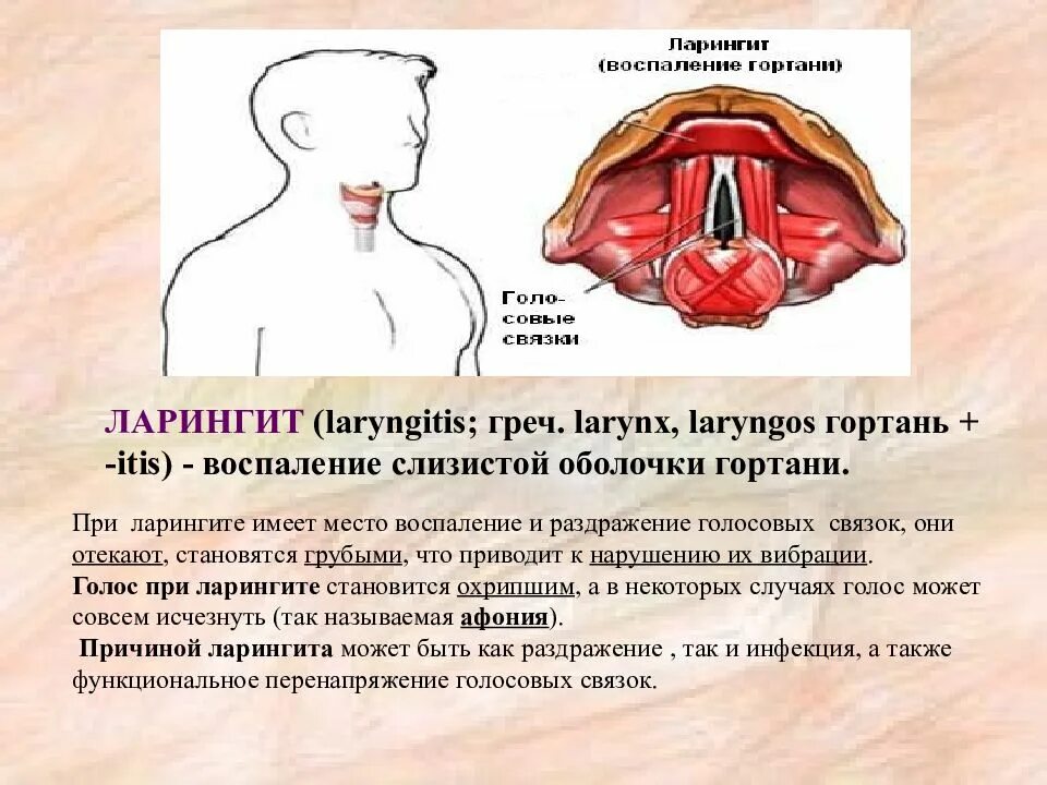 Ларингит клинические проявления. Острый ларингит симптомы. Как лечить голосовые