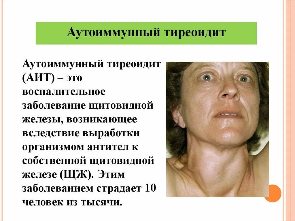 Можно ли при заболевании щитовидной железы. Хронический аутоиммунный тиреоидит синдромы. тиреоидит хашимото синдромы. хронический аутоиммунный тиреоидит гипотиреоз щитовидной железы.