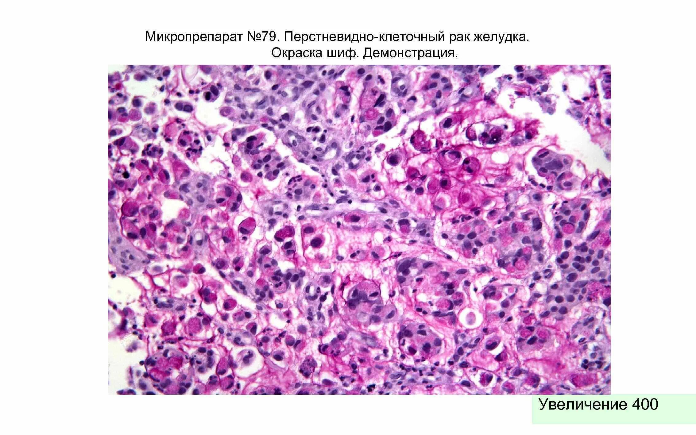 Тубулярная карцинома гистология. Перстневидноклеточная карцинома желудка микропрепарат. Перстневидноклеточная аденокарцинома желудка. Перстневидно-клеточная карцинома желудка гистология.