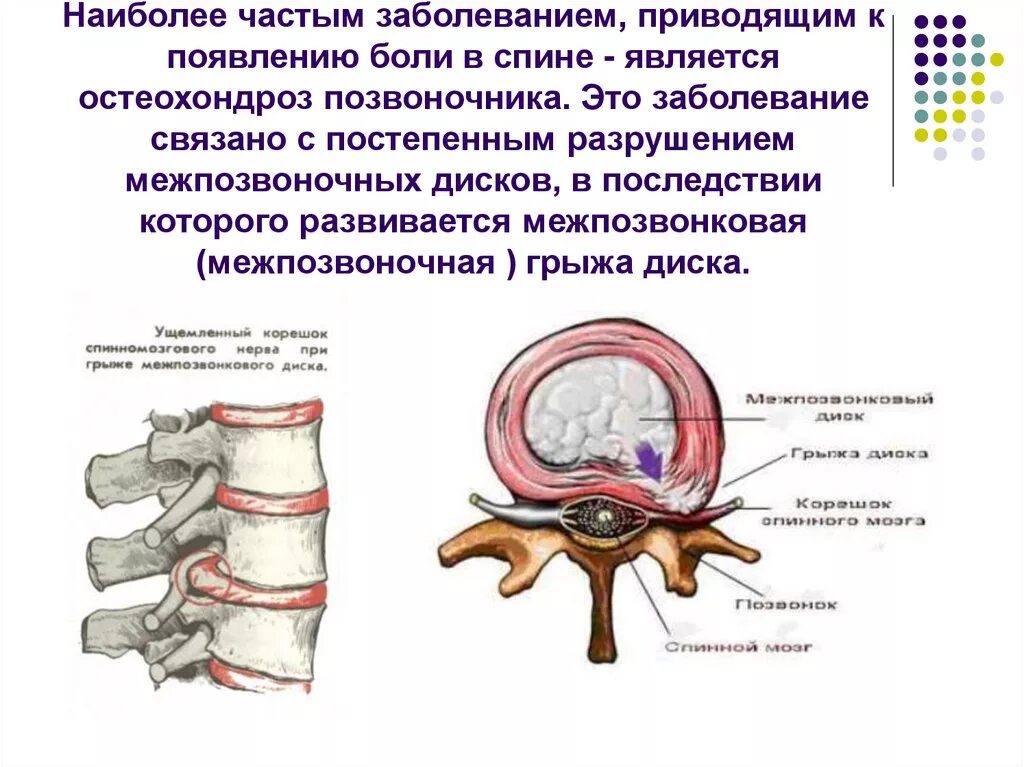 Болит ли протрузия. Остеохондроз шейного отдела грыжа межпозвоночного диска. Остеохондроз протрузии межпозвонковых дисков. Грыжи позвоночника в поясничном отделе схема. Грыжа позвоночника разрез сбоку.