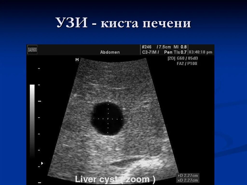 Сонограмма киста печени. Эхинококк селезенки УЗИ. УЗИ почек сонограмма. Эхинококкоз селезенки на УЗИ. Видна ли опухоль на узи