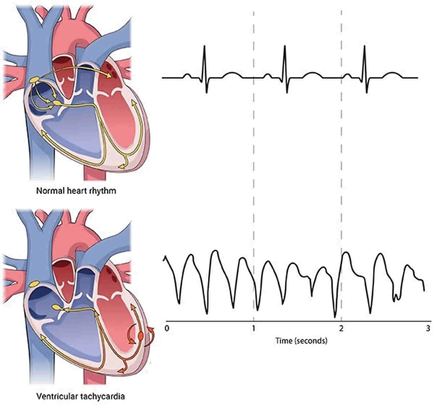 Желудочковые нарушения ритма тахикардия. Нарушение ритма желудочка сердца. Аритмия сердца. Сердечный ритм схема.