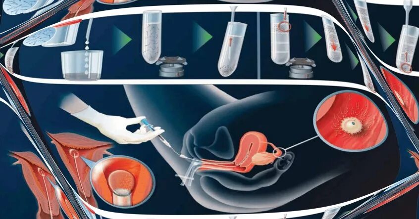 Джон Хантер искусственная инсеминация. Внутриматочная инсеминация (ВМИ). Катетер искусственная инсеминация.