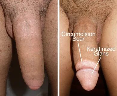 Naked circumcised penis photos-porn Pics & Moveis.