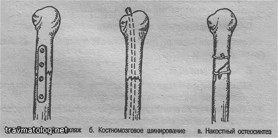 Остеосинтез перелома диафиза плечевой кости блокируемым стержнем. Остеосинтез при переломе диафиза плечевой кости. Перелом пластины остеосинтеза. Остеосинтез средней трети плечевой кости. Перелом плеча пластина