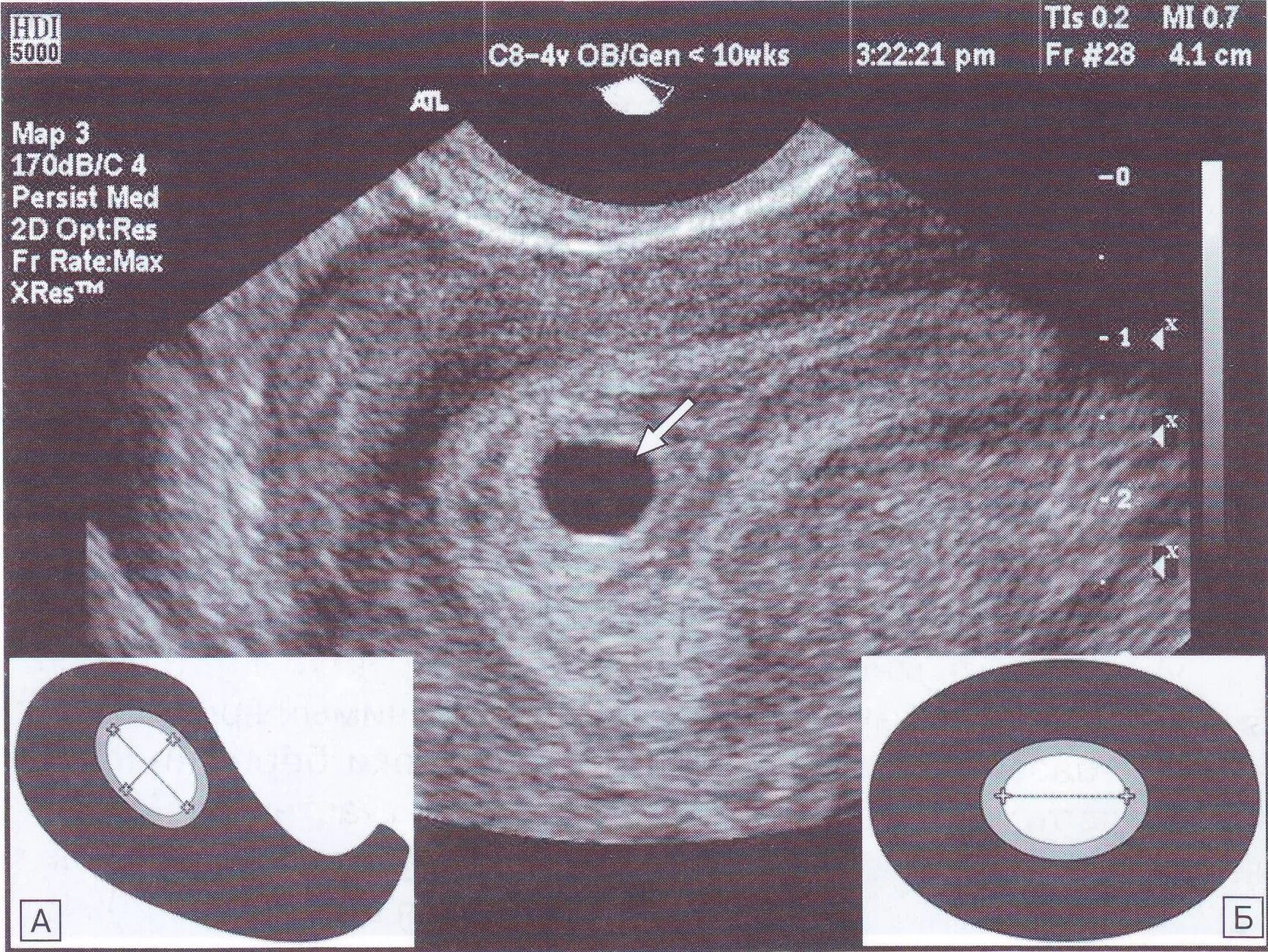 6 недель учиться. Плодное яйцо 4мм эмбрион. УЗИ матки на 5 неделе беременности. Эмбрион на 5 неделе беременности УЗИ. Плодное яйцо по УЗИ 5-6 недель.