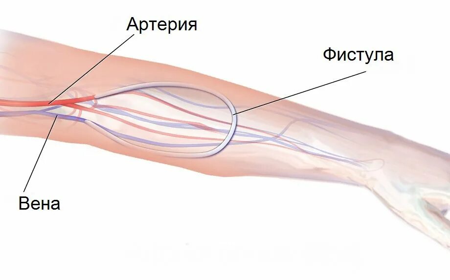 Фистула. Артериально венозная фистула. Артерио-венозная фистула для диализа. Фистула после гемодиализа. Флюстула при гемодиализе.