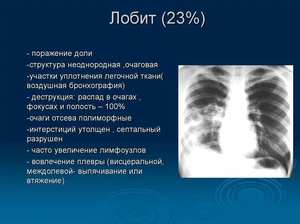 Лобить. Инфильтративный туберкулез Лобит рентген. Туберкулезный Лобит рентген. Инфильтративный туберкулез легких Лобит.