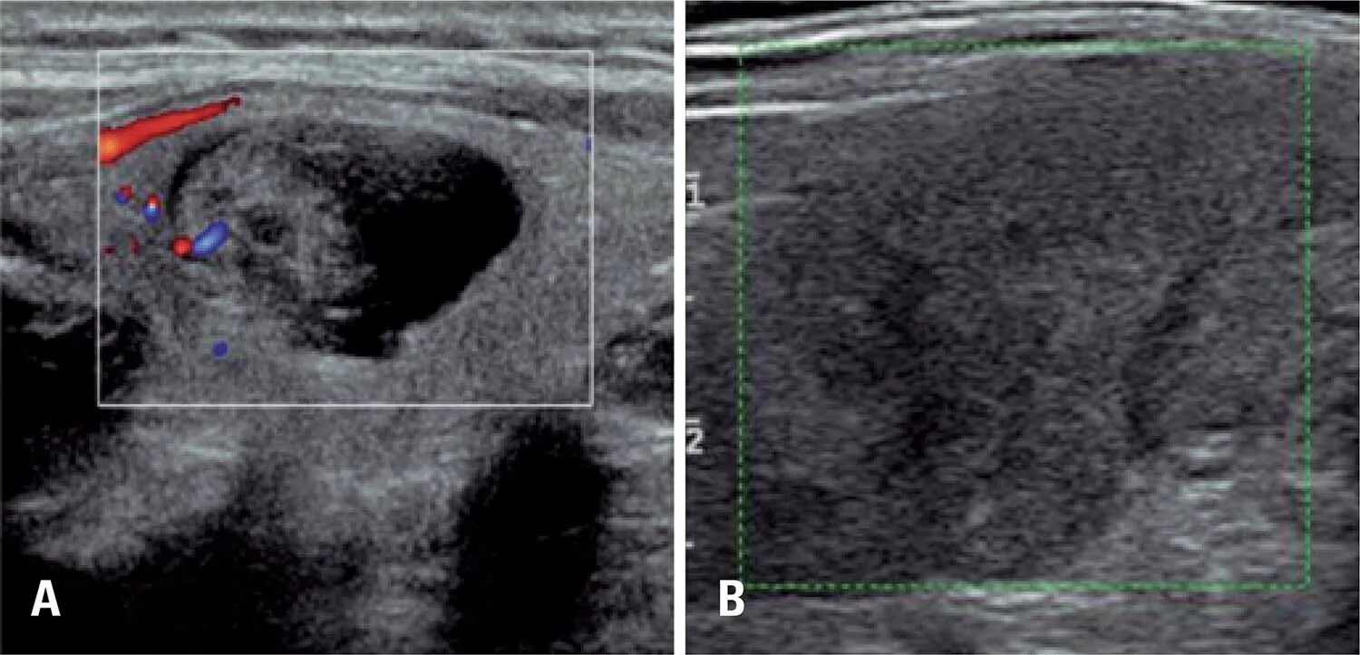Усиленная васкуляризация. Сонограмма щитовидной железы. Кистообразный узел щитовидной железы. Спонгиоформный узел щитовидной железы. УЗИ щитовидной железы ti-rads2.