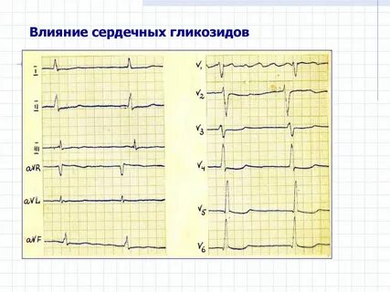 Интоксикация на экг