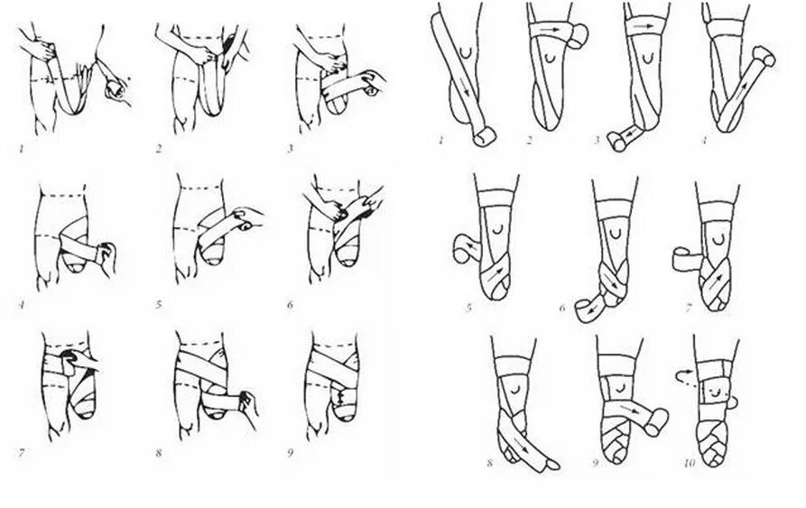 Перевязка самостоятельно. Бинтование культи голени эластичным бинтом. Бинтование культи бедра. Эластичное бинтование культи бедра. Бинтование культи голени после ампутации.