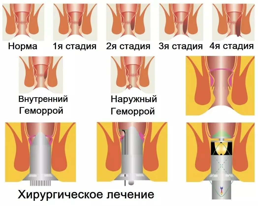 Стул после операции геморроя. Внешний геморроидальный узел. Иссечение наружного геморроидального узла.