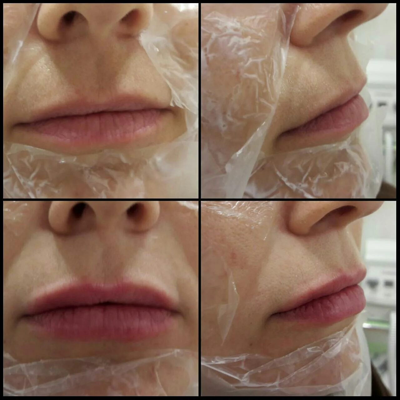 увлажнение губ филлером. увлажнение губ гиалуроновой кислотой. увлажнение губ филлером. увеличение губ гиалуроновой кислотой. увлажнение губ до и после.