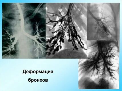 Воспаление в расширенных бронхах