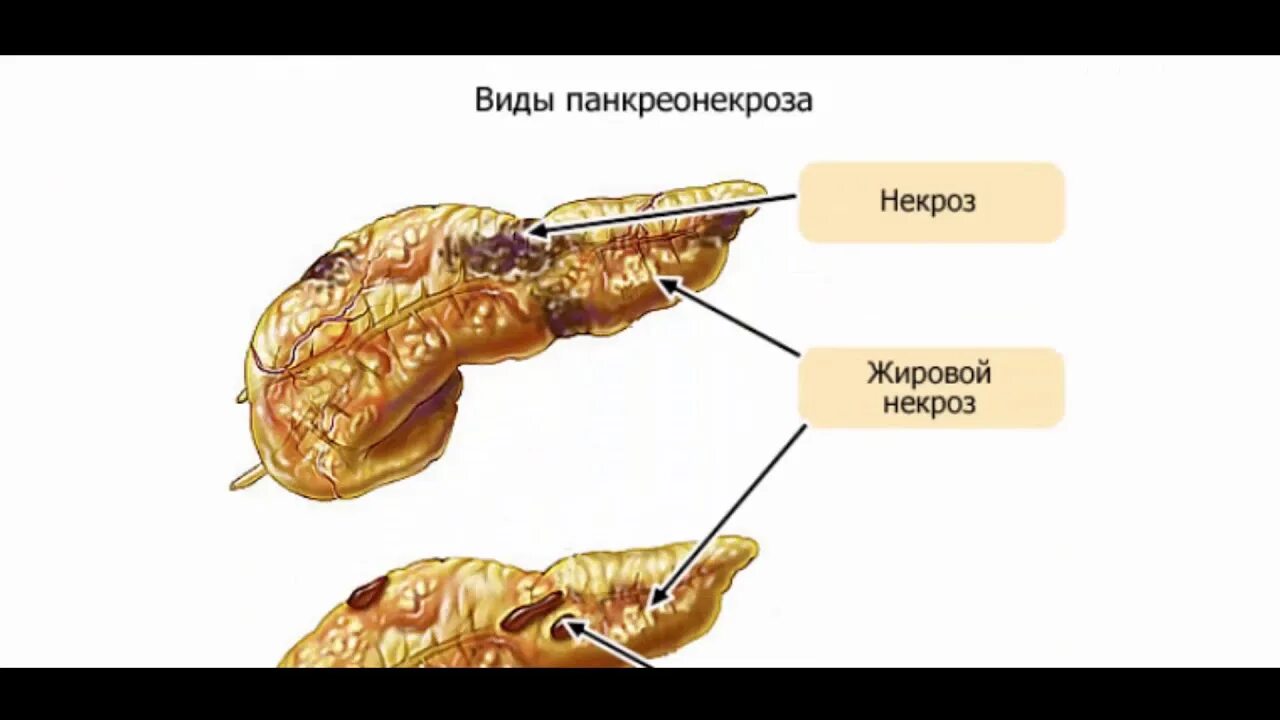 Поджелудочная железа отечность