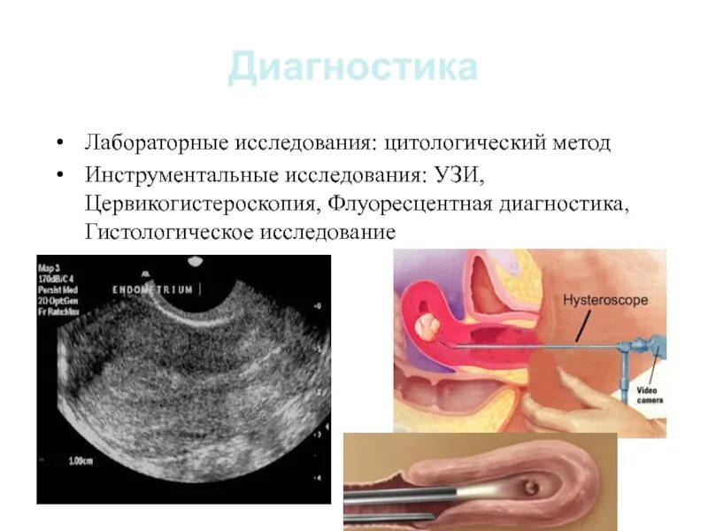 Предраковые заболевания эндометрия. УЗИ инструментальный метод исследования. Фоновые и предраковые заболевания эндометрия. Предраковое эндометрий