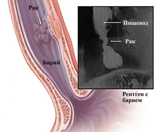 Пищевода с барием. Стеноз пищевода рентген. Полипозиционная рентгеноскопия пищевода. Рентгенологические исследования пищевода с бариевой взвесью. Рентгенологическое исследование с барием пищевода и желудка.