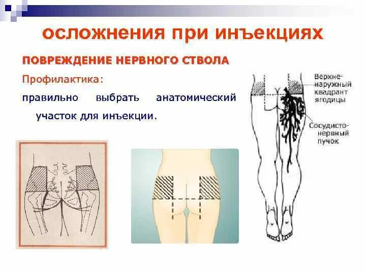 Внутримышечная возможные осложнения. Квадрант для внутримышечной инъекции. Повреждение нервных стволов при внутримышечной инъекции. Профилактика повреждения нервных стволов при инъекции. Введение внутримышечной инъекции в ягодицу.