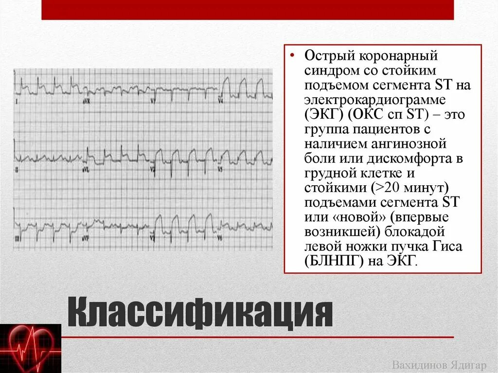 ОИМ С подъемом St ЭКГ. Окс с подъёмом St и без подъема сегмента St. Окс с подъёмом St клинические рекомендации ЭКГ. Острый коронарный синдром без подъема сегмента St ЭКГ. Без подъема st на экг