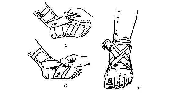 Восьмиобразная повязка на голеностопный сустав техника. Наложить восьмиобразную повязку на голеностопный сустав.. Повязка на голеностопный сустав восьмиобразная техника наложения. Наложение 8-образной повязки на голеностопный сустав.