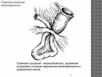 Обтурационная кишечная непроходимость