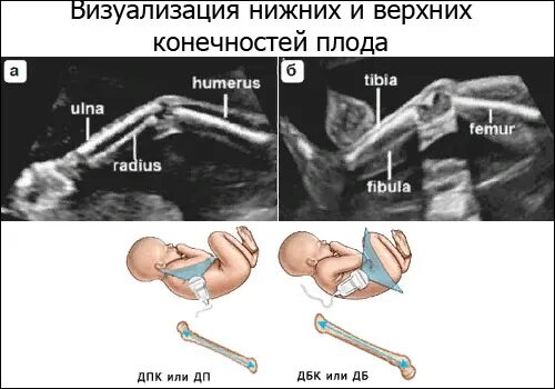 Укорочение трубчатых костей. Длина бедренной кости УЗИ. Длина бедренной кости плода норма. Норма УЗИ бедренной кости. Измерение бедренной кости плод.