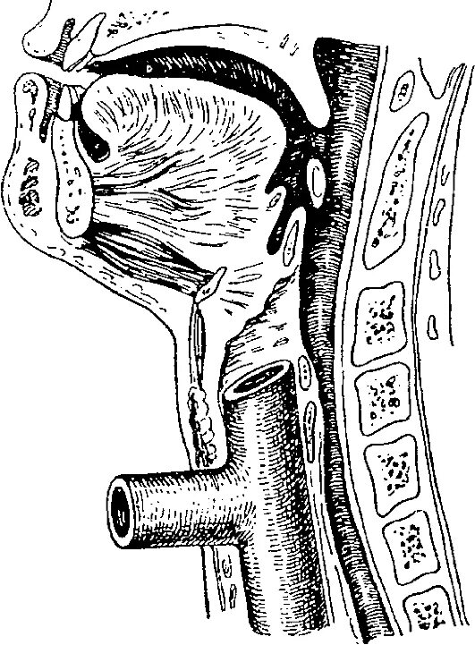 везткулоуретеральный анастомоз. резекция трахеи. резекция трахеи. верхняя трахеостомия техника. циркулярная резекция трахеи схема.