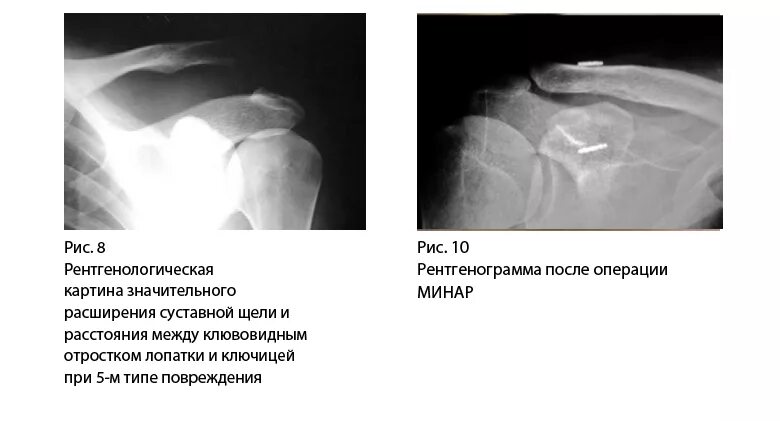 Дегенеративные изменения акромиально ключичного сустава. Вывих акромиально-ключичного сустава рентген. подвывих акромиального конца ключицы рентген. артроз грудино-ключичного сочленения рентген. подвывих плечевого сустава рентген.