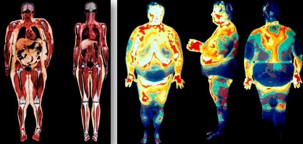 Висцеральный жир анатомия. Подкожный и висцеральный жир. Висцеральная жировая ткань. Толстый человек анатомия