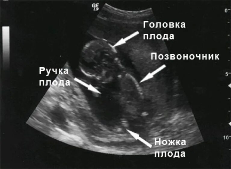 Малыш на 14 неделе. Как выглядит плод в 14 недель на УЗИ. УЗИ плода на 14 неделе беременности. УЗИ 13-14 недель беременности. Фото УЗИ 13-14 недель беременности.