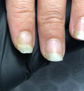 Можно ли онихолизис покрывать гель лаком ногтей