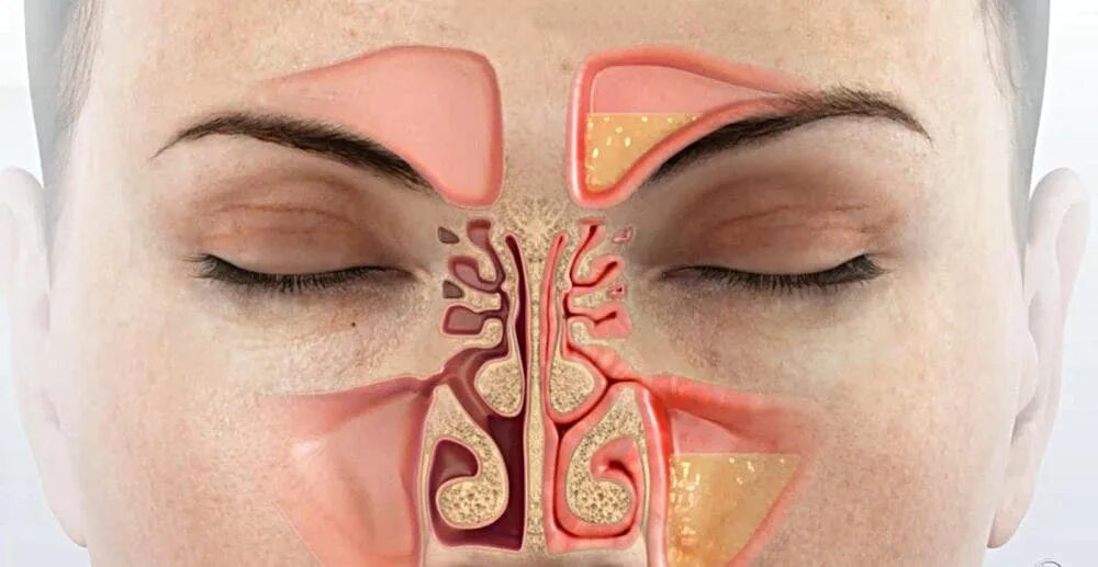 Гайморовы пазухи гайморит. Вазомоторный ринит,гайморит. Болезнь когда заложен нос