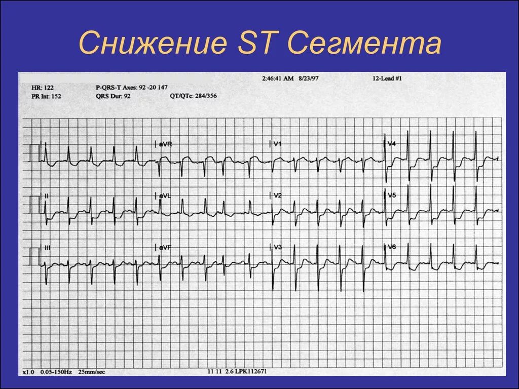 Депрессия сегмента st. Косонисходящая депрессия сегмента St. Сегмент St на ЭКГ на изолинии. Косонисходящая депрессия сегмента St на ЭКГ. Депрессия сегмента St на ЭКГ v5 v6.