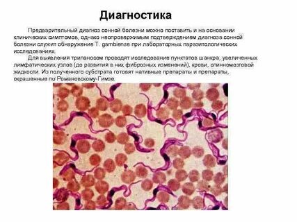 Симптомы сонной болезни