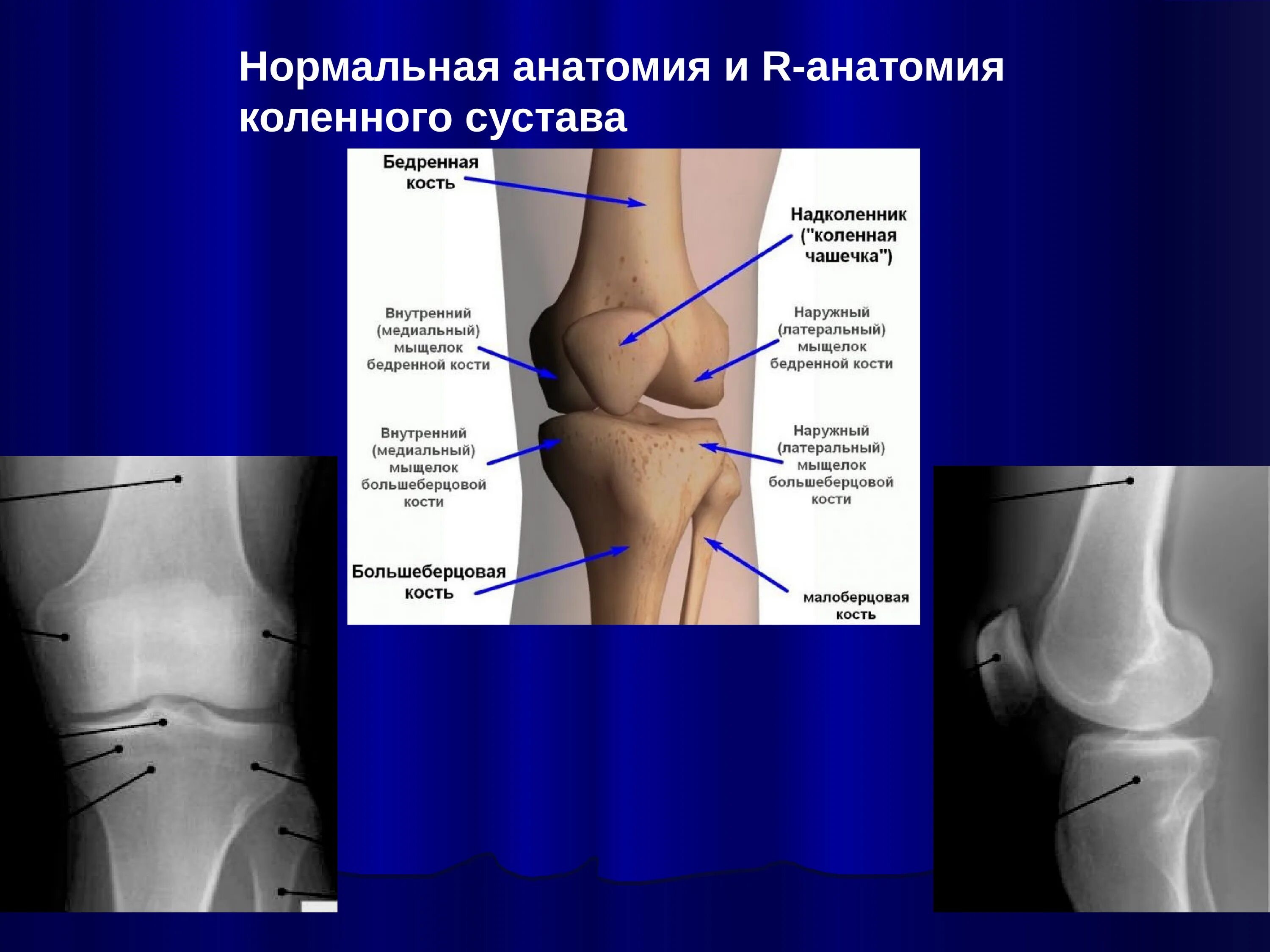 Анатомия коленного сустава кости. Анатомия коленного сустава мыщелки. Медиальный мыщелок бедренной кости. Внутренний мыщелок большеберцовой кости.