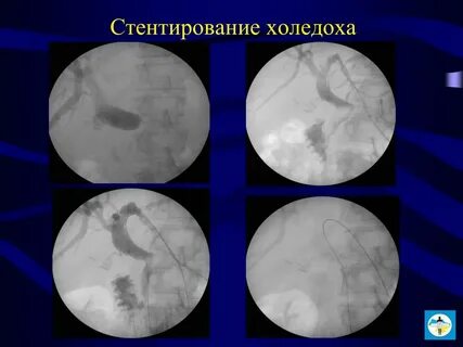 Стентирование желчного протока