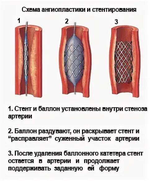 Болит стент. Ангиопластика сосудов нижних конечностей. Баллонная ангиопластика. Баллонная ангиопластика нижних конечностей.