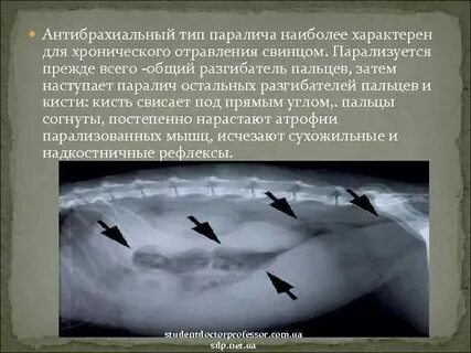 Отравление свинцом как называется
