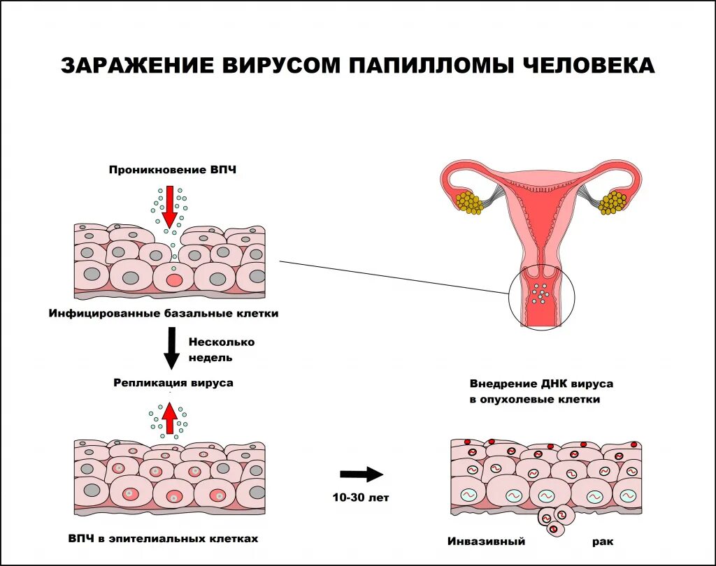 Мироспопилома человека. Вируспопиломы человека. Папилломавирусной инфекции. Вирус human