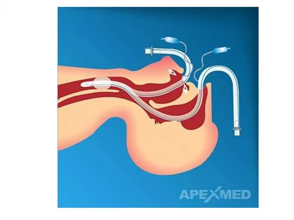 Трубка при наркозе. Трахеальная аспирация. Интубационная трубка с манжетой внутри человека. Эндотрахеальная трубка Мерфи. Интубационная анестезия.