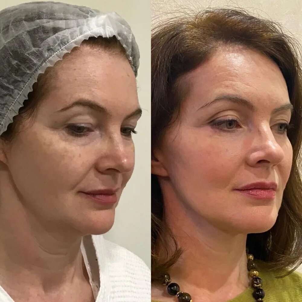 фейслифтинг для лица. 3s лифтинг. 3s лифтинг. лифтинг нефертити ботоксом. подтяжка лица до и после.