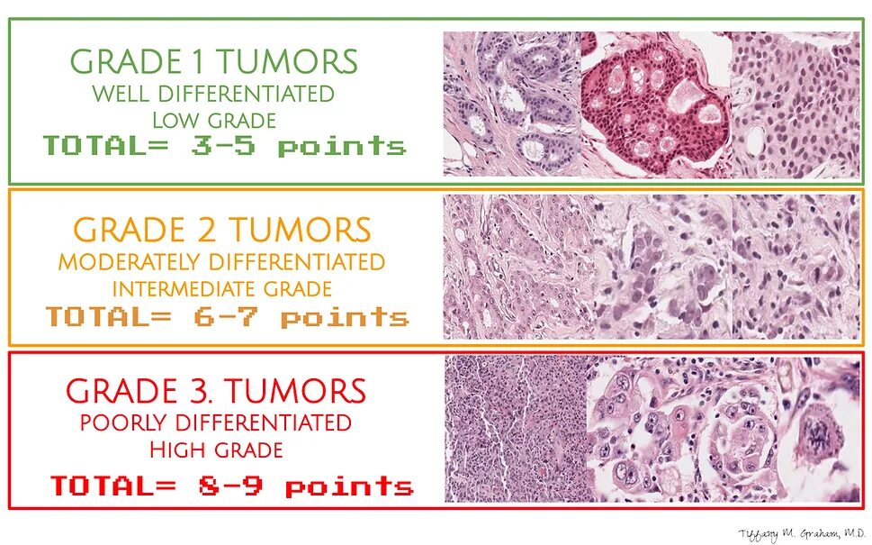 Low grade яичников. Low Grade и High Grade в онкологии.