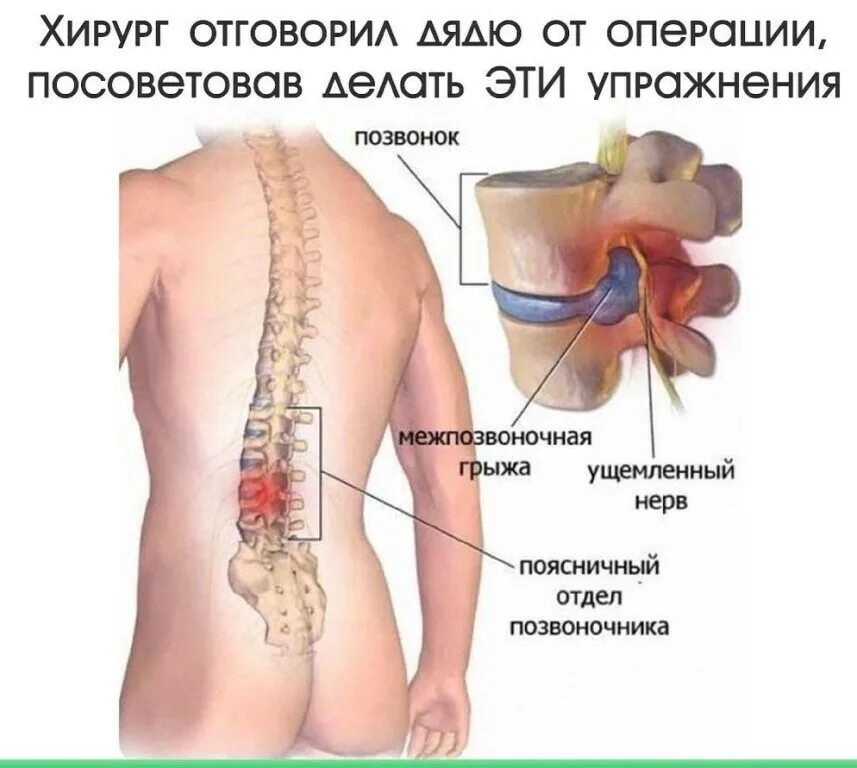 Болит спина защемление. Пояснично-крестцовый радикулит. Межпозвоночная грыжа. Грыжа позвоночника поясничного отдела.