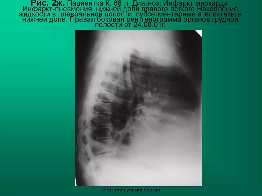 Пневмония в правой нижней доле. Инфарктная пневмония на рентгенограмме. Инфарктная пневмония диагноз. Пневмония в нижней доле правого легкого.