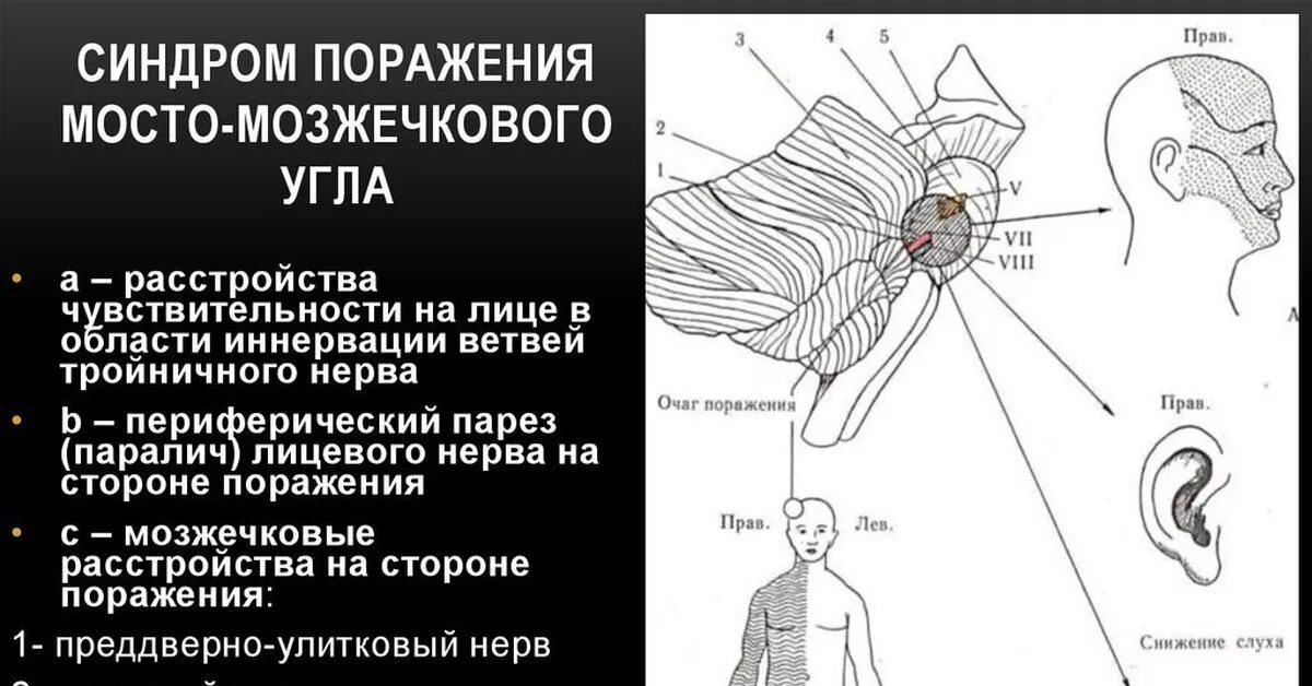 Нарушение функции мозжечка. Синдром поражения нервов мосто-мозжечкового угла неврология. Синдром мостомозжечкового угла симптомы. Поражение ядра тройничного нерва. Синдром поражения структур мосто-мозжечкового угла..