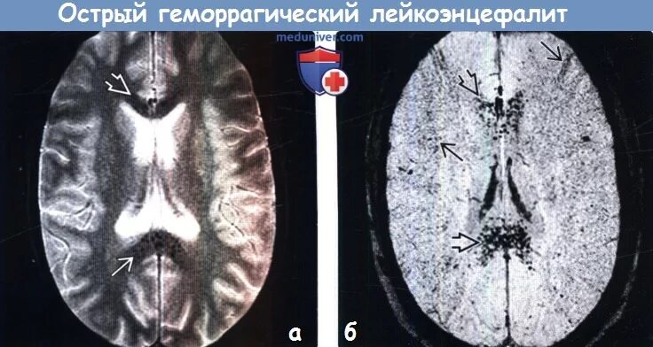 Лейкоэнцефалит. Лейкоэнцефалит шильдера. острый геморрагический лейкоэнцефалит. лейкоэнцефалит шильдера мрт.