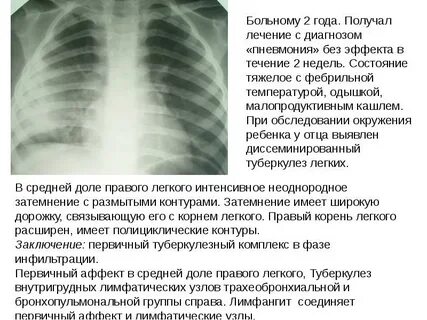 Внутригрудная лимфаденопатия